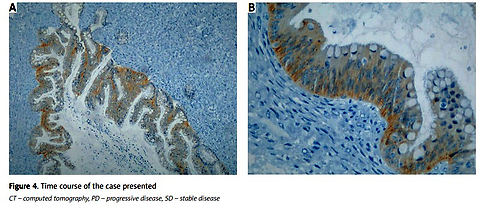 Molecularly guided treatment in recurrent mucinous ovarian carcinoma