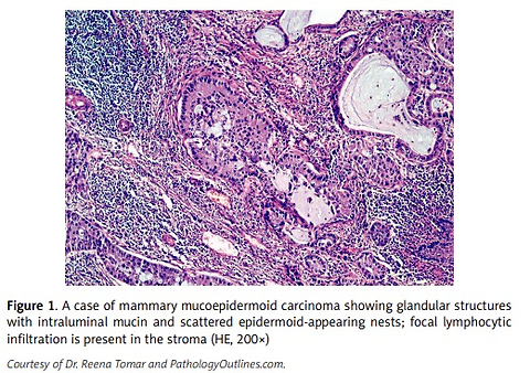 A clinicopathologic and survival analysis of mucoepidermoid carcinoma of the breast