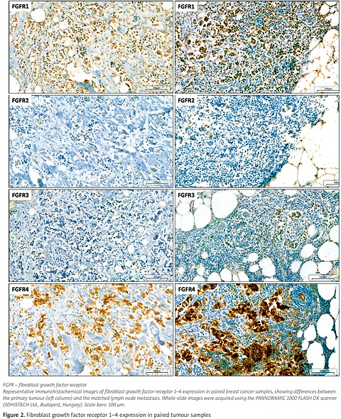 Fibroblast growth factor receptor 1 status discordance between primary breast tumours and lymph node metastases is associated with peripheral blood circulating tumour cell burden