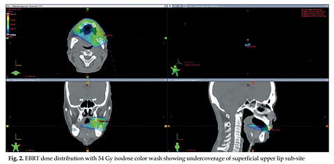Collaborative design and additive manufacturing of a patient-specific high-dose-rate surface mold applicator for upper lip plesiotherapy