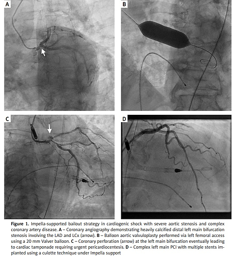 Impella-supported left main percutaneous coronary intervention following balloon aortic valvuloplasty: a bridge-to-TAVI strategy