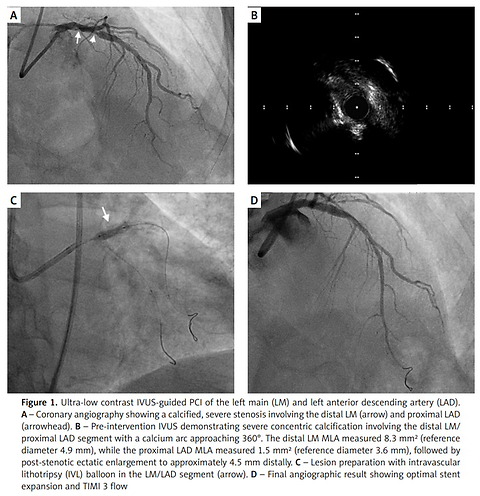 Ultra-low contrast intravascular ultrasound-guided percutaneous coronary intervention of the left main and left anterior descending artery in advanced chronic kidney disease