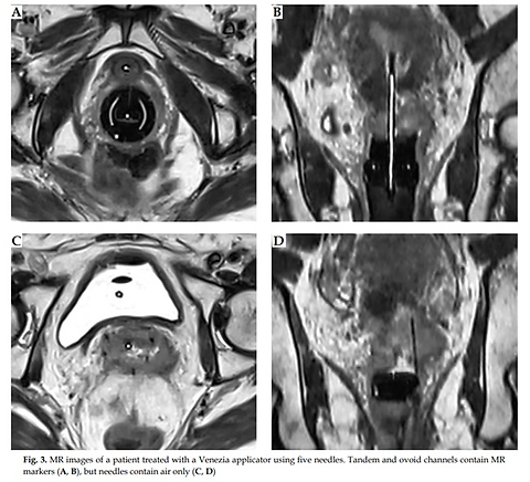 Geometric accuracy of applicator and needle reconstruction in gynecological brachytherapy using low-field magnetic resonance imaging