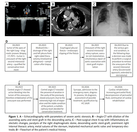 Complex decision-making in severe bicuspid aortic stenosis after multiple thoracic interventions