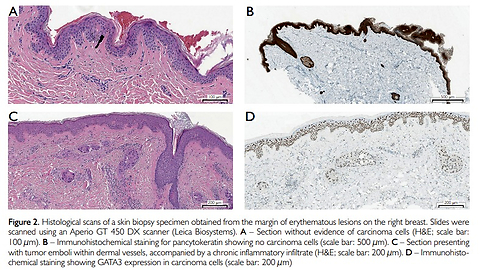 Cutaneous Metastases of Breast Cancer During Anti-HER2 Therapy: Diagnostic Challenges