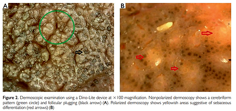 A Microscopic Mosaic: A Mélange of Intraluminal Sebocytes and Apocrine Calcifications in Nevus Sebaceus