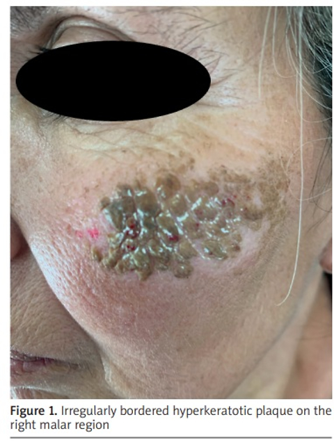 Bilateral symmetrical facial terra firma-forme dermatosis: a diagnostic pitfall