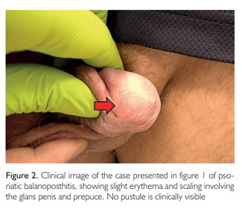 Dermatoscopy and treatment of Pustular Psoriatic Balanoposthitis: a Preliminary report