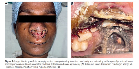 The Cryptic Invader: Midfacial Destruction in Extranodal NK/T-Cell Lymphoma – Case report with Narrative Review