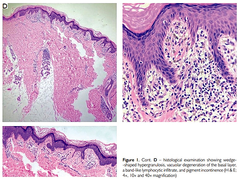 When It’s Not Eczema: A Case of Confluent Lichen Planus