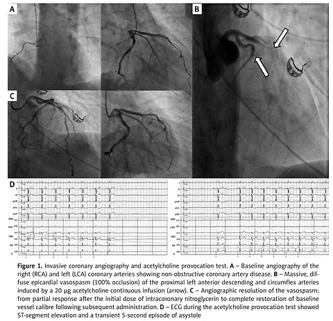 Looking beyond stenosis: unmasking vasospastic angina through comprehensive invasive assessment