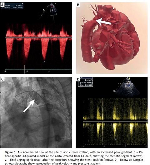 Endovascular treatment of postsurgical aortic recoarctation in a young adult with complex congenital heart disease