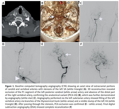 When anatomy challenges access: successful thrombectomy in posterior cerebral artery stroke with PICA-VA variant