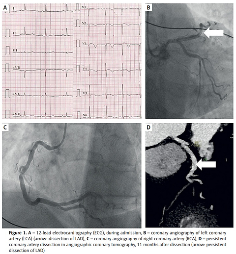 Spontaneous coronary artery dissection presenting as myocardial infarction in a postmenopausal woman