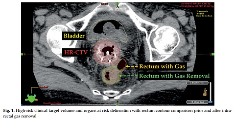 Dosimetric impact of intrarectal gas removal by Foley catheter on image-guided adaptive brachytherapy in cervical cancer patients