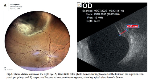 Orbital hematoma following ruthenium-106 plaque brachytherapy: Potential dosimetric implications