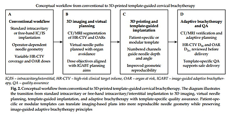 Three-dimensional-printed template-assisted image-guided brachytherapy for cervical cancer: Technology, dosimetry, and clinical implementation