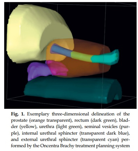 Temporary prostate brachytherapy alone or as boost: Single-institution experience on dose-response assessment focusing on sphincter-related urinary toxicity