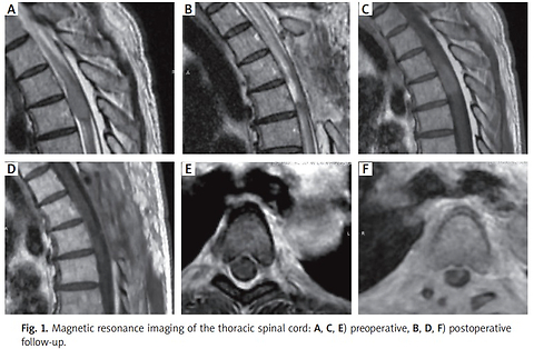 Intermediate-grade melanocytic meningeal neoplasm of the thoracic spine