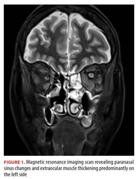 Sinonasal presentation of IgG4-related disease: a diagnostic challenge mimicking chronic sinusitis