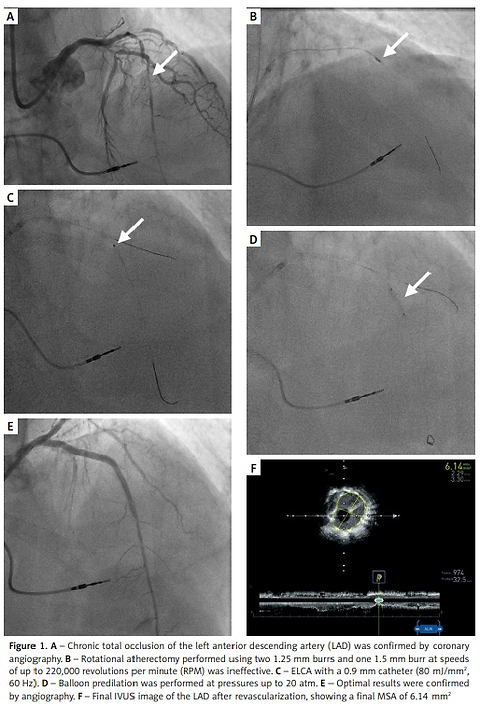 Successful excimer laser coronary atherectomy after failed rotational atherectomy in a balloon-uncrossable chronic total occlusion of the left anterior descending artery