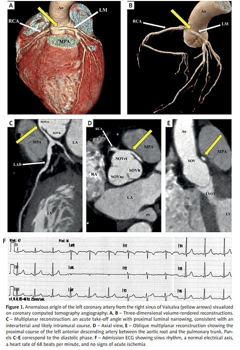 Anomalous left coronary artery origin unmasked by non-ST-elevation myocardial infarction