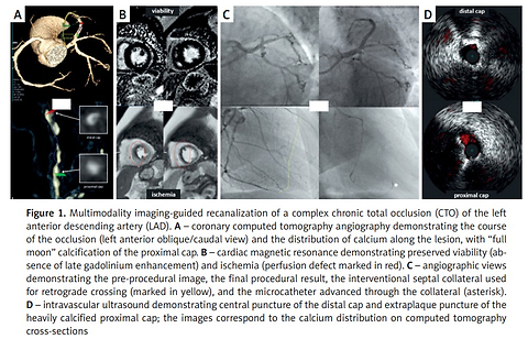 Multimodality imaging-guided recanalization of a complex left anterior descending chronic total occlusion