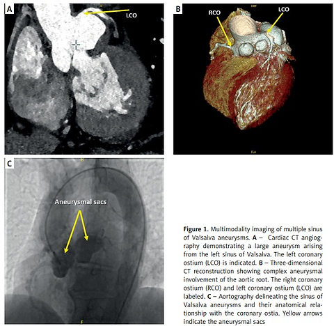 Multiple sinus of Valsalva aneurysms with intraaneurysmal thrombus treated by Bentall surgery