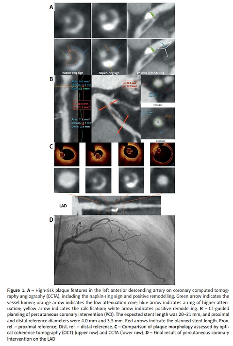 From coronary computed tomography angiography to the cath lab: computed tomography-guided percutaneous coronary intervention of a high-risk left anterior descending artery lesion