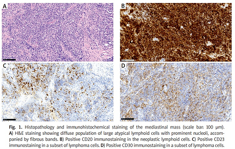 Successful treatment of central nervous system relapse of primary mediastinal large B-cell lymphoma with the R-MIV regimen: a case report