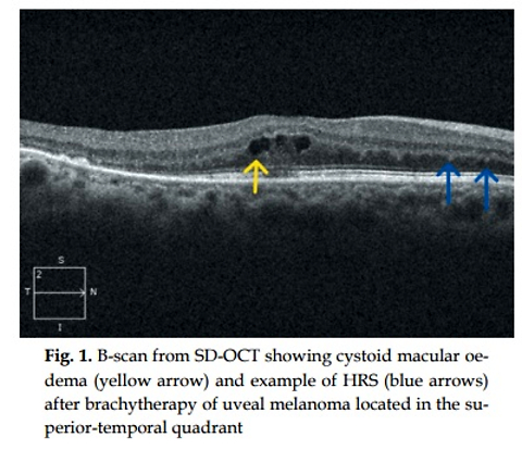 Early optical coherence tomography biomarkers of radiation maculopathy following ruthenium-106 brachytherapy for uveal melanoma in long-term follow-up
