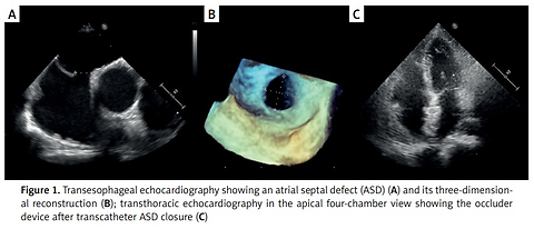 Pregnancy after transcatheter closure of atrial septal defects: safety and clinical outcomes