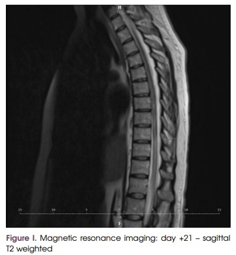 Irreversible paraplegia due to transverse myelitis as a rare complication of CAR T-cell therapy in a patient with B-cell lymphoma
