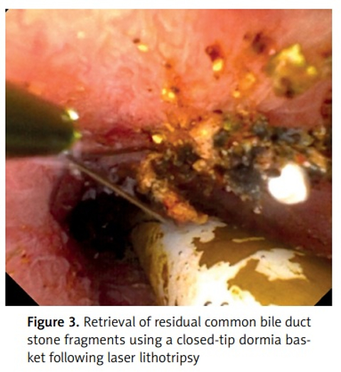 Laparoscopic cholangioscopy with laser lithotripsy of common bile duct stone using flexible ureteroscope: a case report and literature review