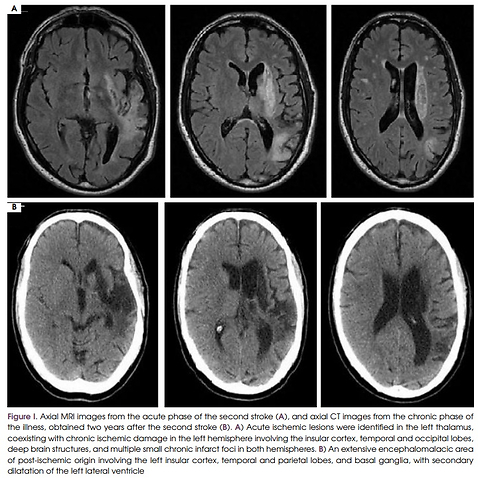 Differential language recovery in an English-Polish bilingual individual with severe aphasia: a four-year longitudinal case study