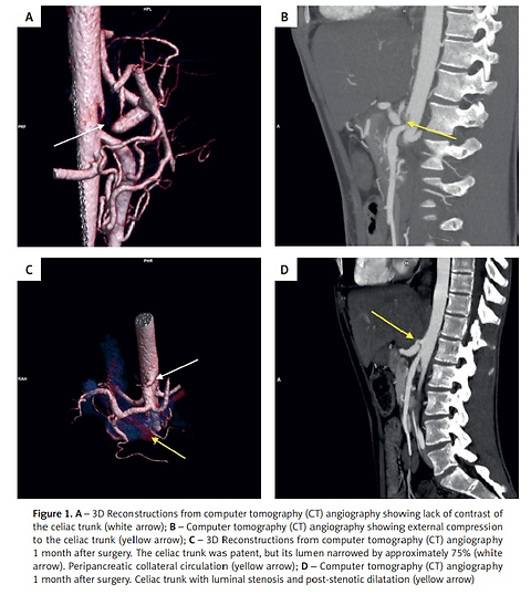 Crohn’s disease exacerbation or Dunbar syndrome?