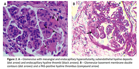 Long-term results of treatment with direct-acting antivirals, corticosteroids, plasmapheresis, and rituximab in a patient with cryoglobulinaemic vasculitis and HCV infection: a case report and review of the literature