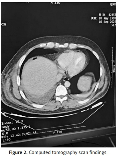 Necrotising fasciitis arising from a drain site in a 35-year-old male following laparoscopic cholecystectomy