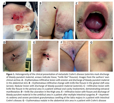 Metastatic Crohn’s disease unmasked: from elusive skin clues to diagnosis and treatment – a comprehensive review