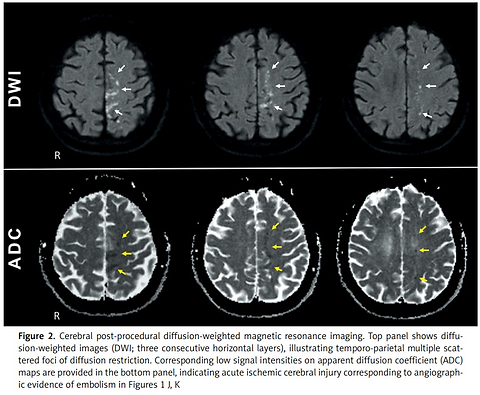 Intravascular lithotripsy for highly calcified carotid stenoses: distal (filter) protection may not suffice