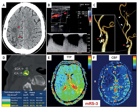 Image-guided decision-making in contemporary carotid revascularization