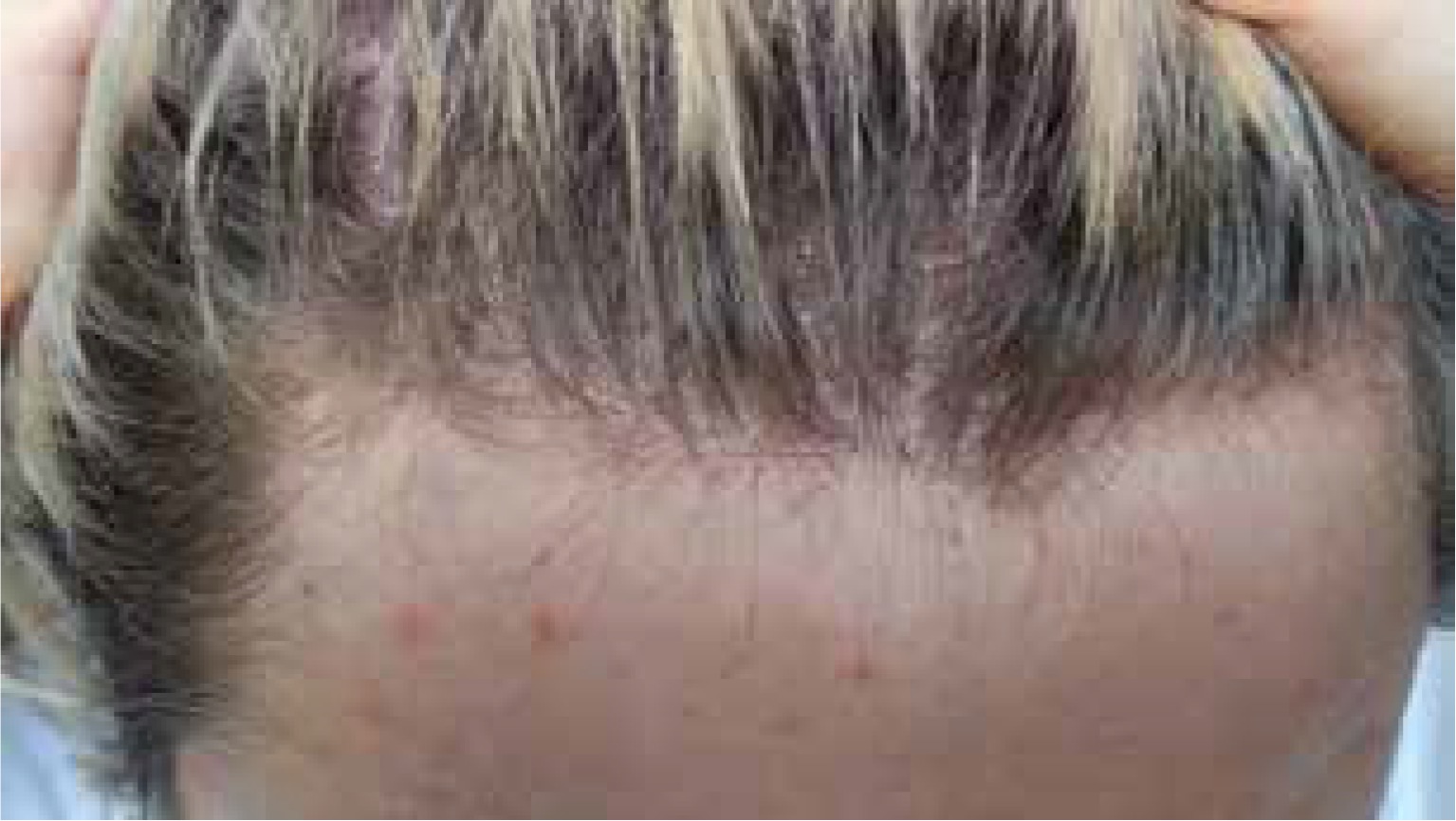 Female Hair Loss Causes Diagnoses and Treatment  New York