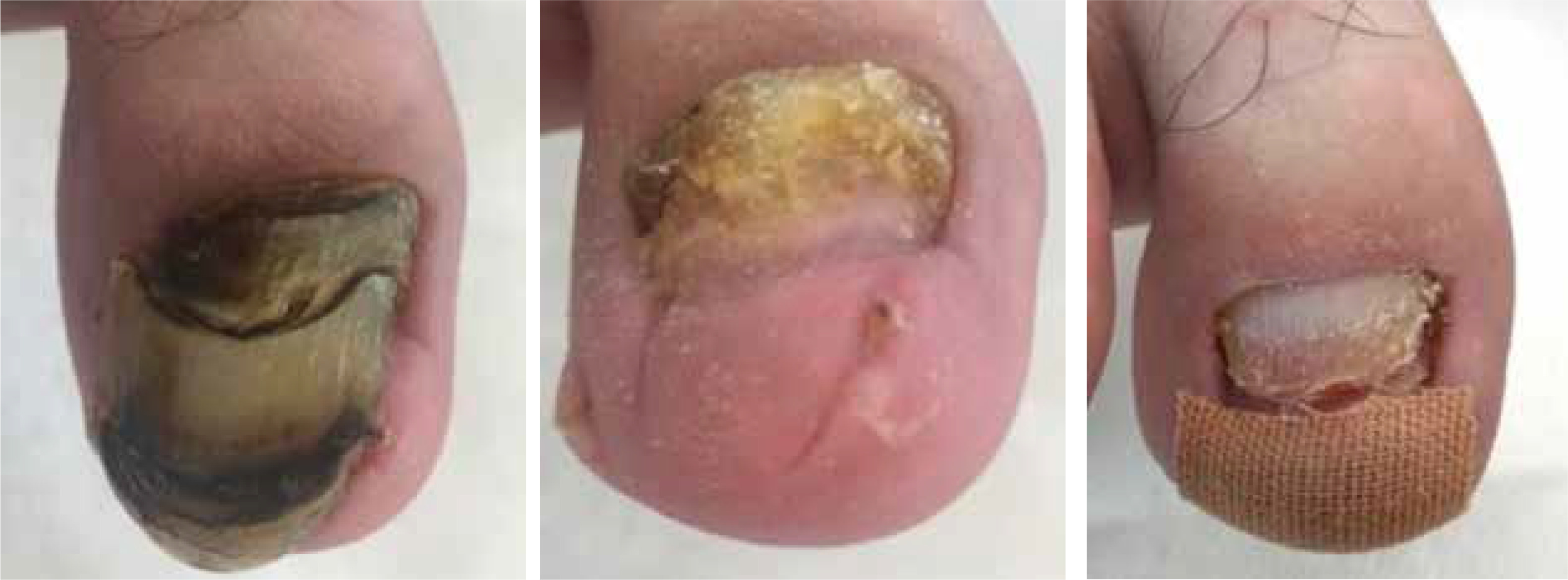 Hematoma under the toenail - PiedReseau