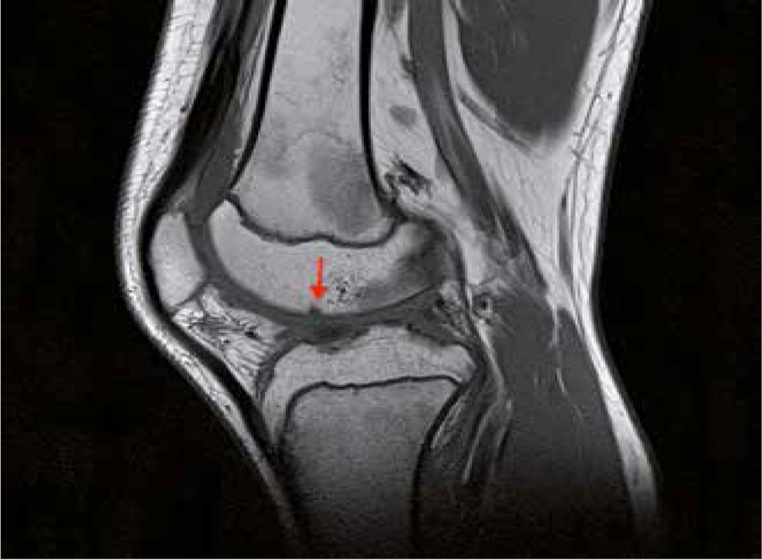 resonance imaging of the knee joint in juvenile idiopathic
