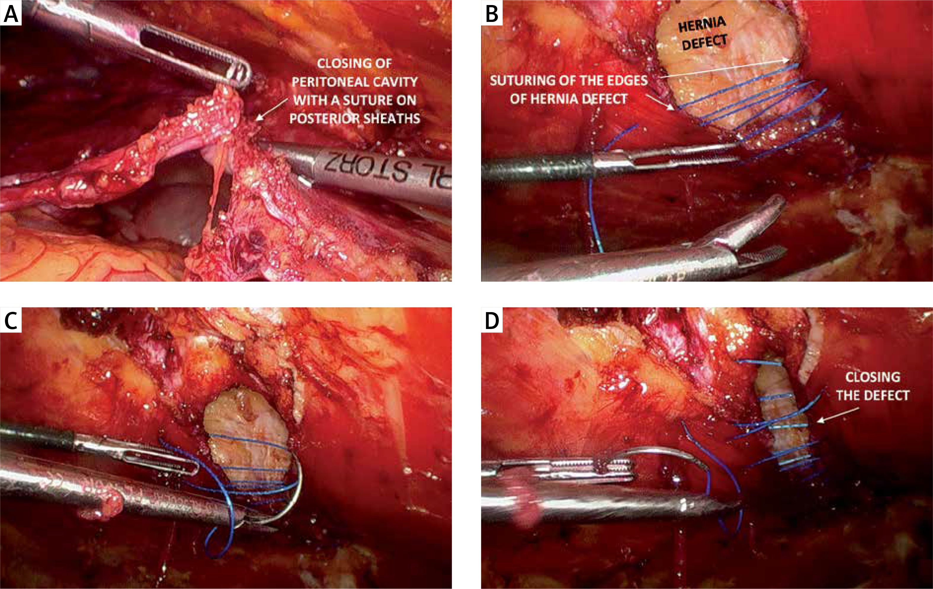 Laparoscopic enhanced-view totally extraperitoneal Rives-Stoppa repair  (eTEP-RS) for ventral and incisional hernias–early operative outcomes and  technical remarks on a novel retromuscular approach