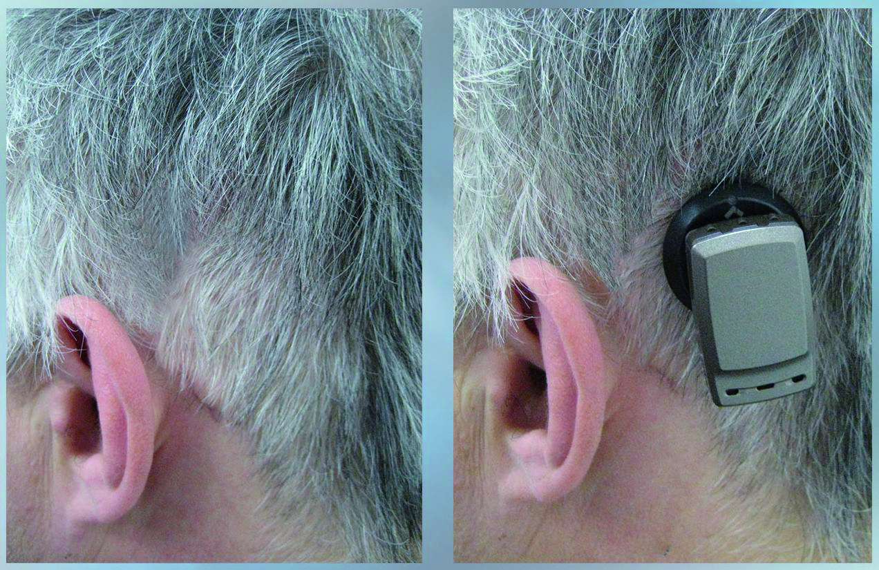 Nowoczesny Implant S uchu W Szpitalu Biziela Mened er Zdrowia Termedia nowoczesny-implant-s-uchu-w-szpitalu-biziela-mened-er-zdrowia-termedia