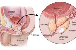 Kiedy Można Uniknąć Biopsji Raka Prostaty? - Onkologia – Termedia