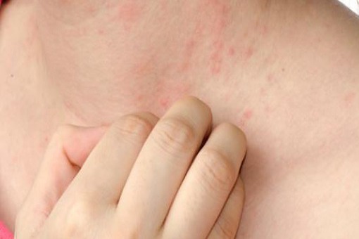 Skorna Postac Sarkoidozy Dermatologia Termedia