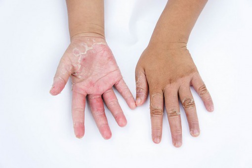 Najczestsze Przyczyny Alergicznego Kontaktowego Zapalenia Skory U Dzieci Dermatologia Termedia