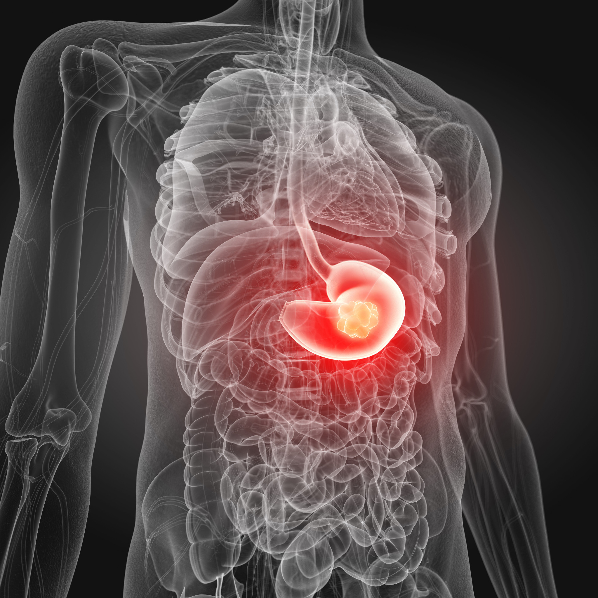 Cât de eficientă este prevenirea cancerului de stomac – determină oamenii de știință de la Universitatea de Medicină din Wrocław
